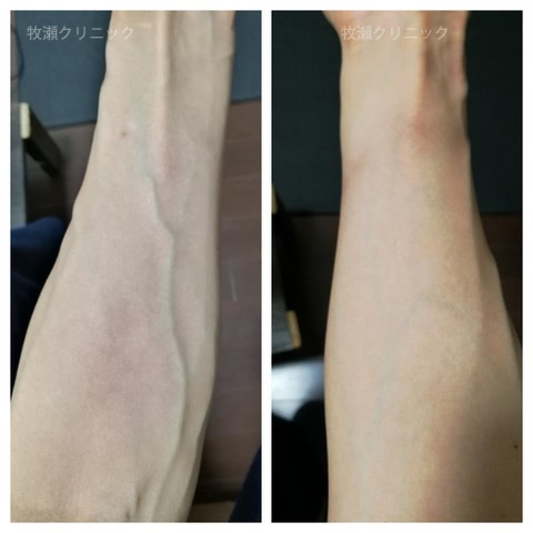 両方の手に結節性痒疹治療の30日後