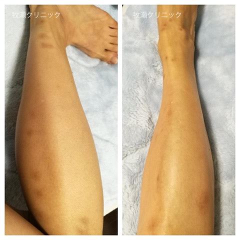 両方の足に結節性痒疹