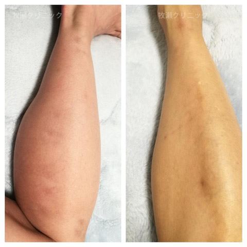 両方の足に結節性痒疹治療の30日後